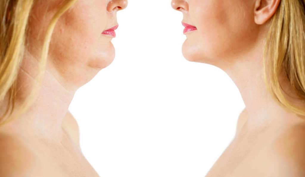 Double Chin treatment Lower Feltham before and after results