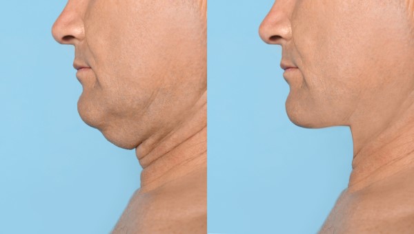 Which Non-Surgical Treatments Work Best for Jowls and Loose Skin Lower Feltham?