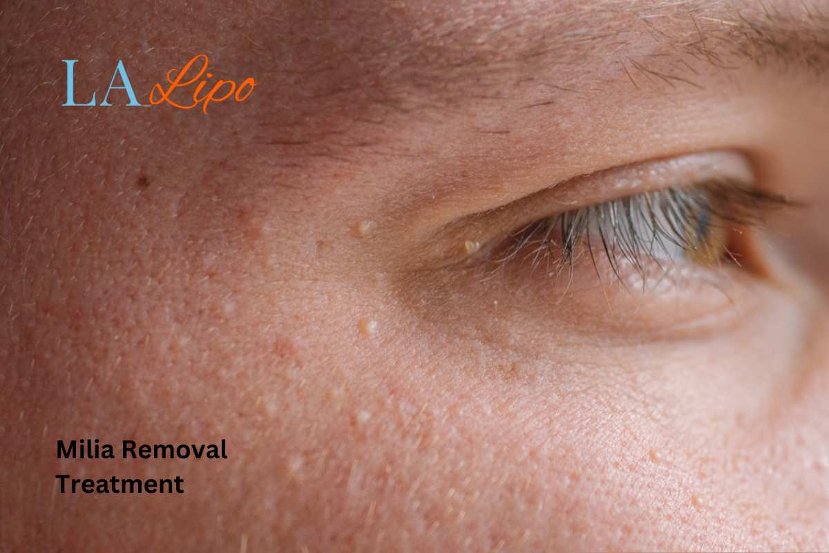 Cryopen Milia Removal: Is It the Easiest and Safest Option Lower Feltham?