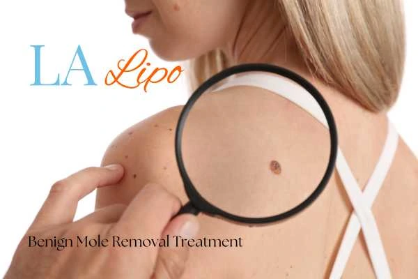 Woman having her inspection of blemish before mole removal Lower Feltham