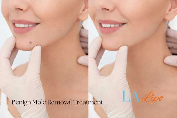 Before and after mole removal Lower Feltham treatment