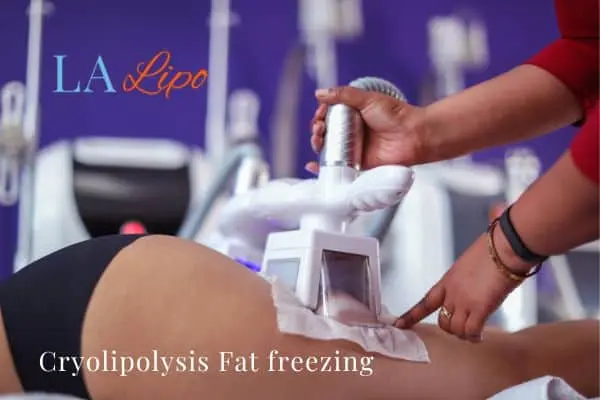 women getting fat freezing Lower Feltham