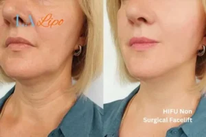 hi-fu for wrinkles Lower Feltham before and after results