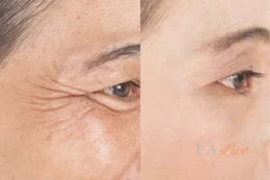 Before and after results of woman - HI-fu wrinkles reduction treatment Lower Feltham
