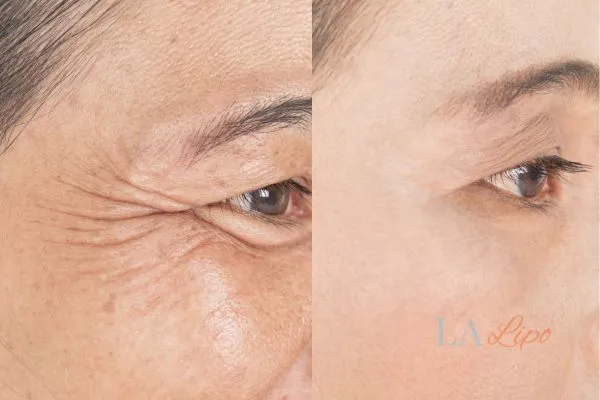 Before and after results of woman - HI-fu wrinkles reduction treatment Lower Feltham
