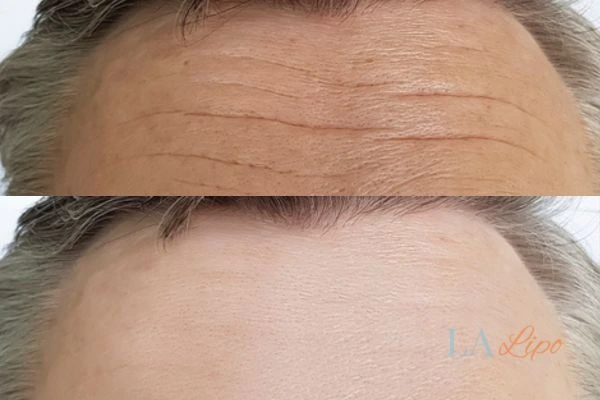 results of HIFU Lower Feltham on mans forehead to help reduce lines and wrinkles