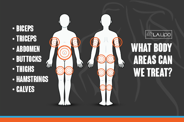 Graphic to show areas you can have LA-EMS Body Sculpting Lower Feltham treatment.