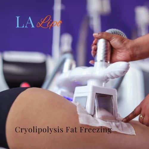 fat freezing - Cryolipolysis Lower Feltham