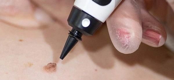 skin tag removal using cryopen Lower Feltham