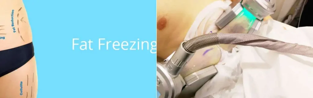 multi areas of a persons body having coolsculpting Lower Feltham treatment