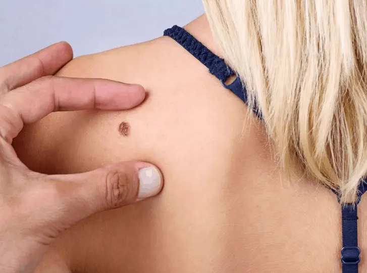woman having mole removal Lower Feltham consultation before treatment.