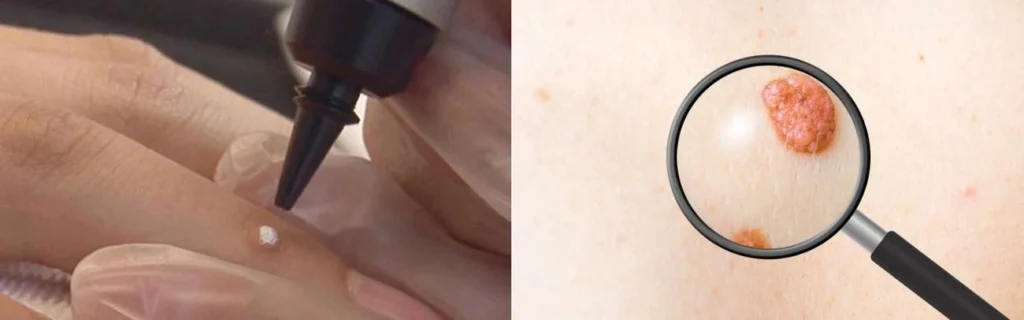 Person getting moles removed with cryopen Lower Feltham