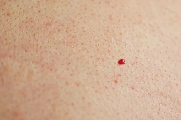 close up of a cherry angioma Lower Feltham