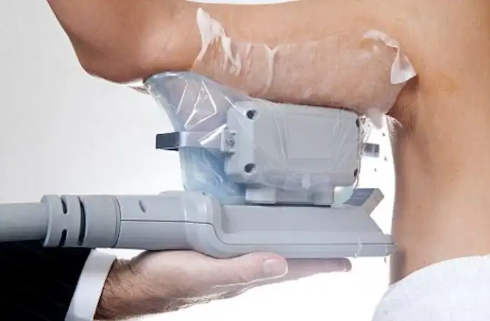 Picture of fat freezing Lower Feltham on the upper arms.