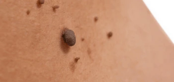 image of a skin tag Lower Feltham