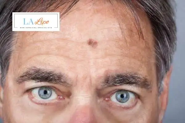 Solar Lentigo Removal Lower Feltham image of man with mark on his forehead