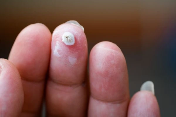 wart on person finger - cryotherapy to treat from LA LIPO Lower Feltham