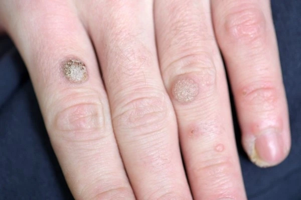 photo of warts on person hand - see wart removal Lower Feltham from LA LIPO