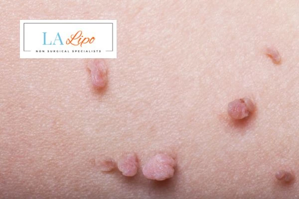 Does cryopen skin tag removal Lower Feltham hurt? Find out now call our team today!