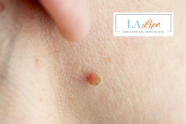 Book skin tag removal Lower Feltham today speak to our team now!