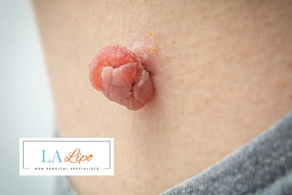 Interested in skin tag removal Lower Feltham? Concerned about the pain? Find out more today!