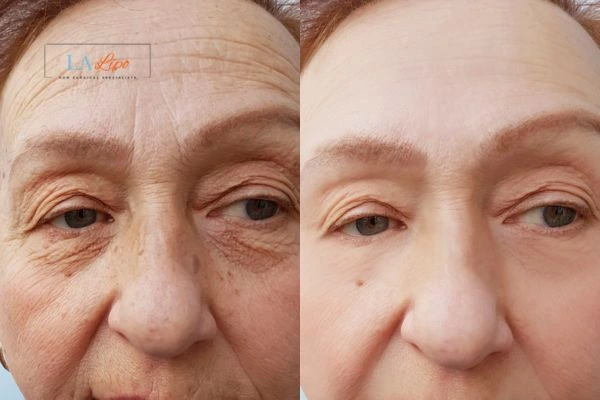 The powerful benefits of Morpheus8 Treatment Lower Feltham - Call Our team today!
