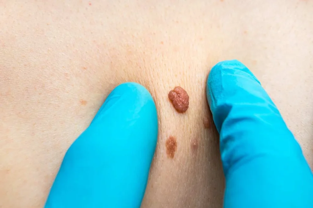 LA LIPO Cryopen Lesion Removal Prices Lower Feltham