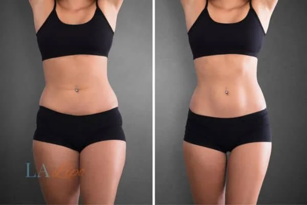 before and after results of non-surgical treatment to help a woman's body image and mental health Lower Feltham