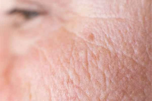 close up picture of a woman's face showing an age spot Lower Feltham