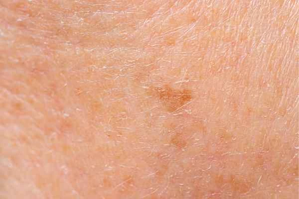 close up picture of age spots Lower Feltham