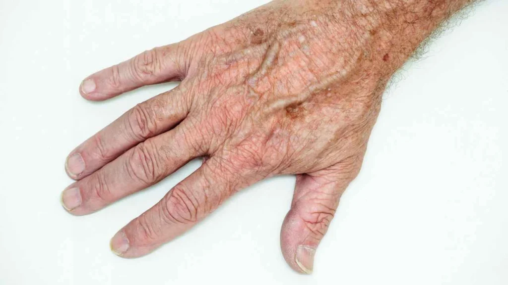 Male hand showing age spot Lower Feltham