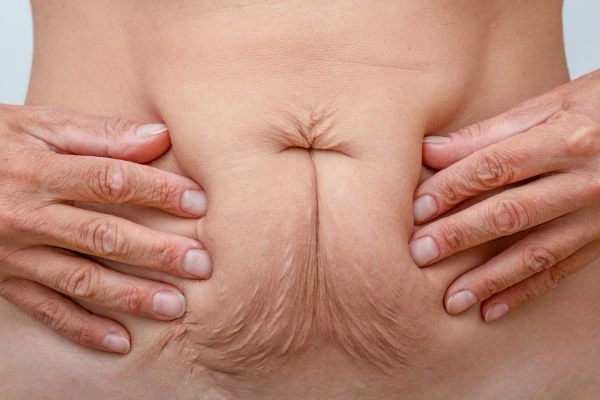 Image of a woman's stomach with loose skin - example of skin tightening Lower Feltham options