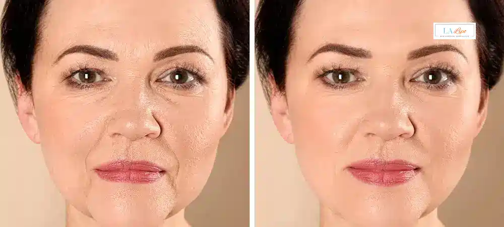 How Long Does It Take to See Results and How Long Do They Last Lower Feltham?