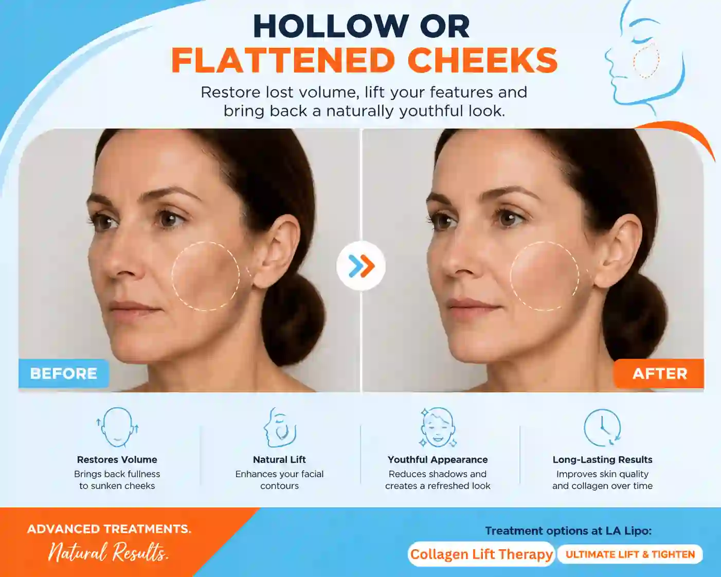 Sign #4: Hollow or Flattened Cheeks Lower Feltham